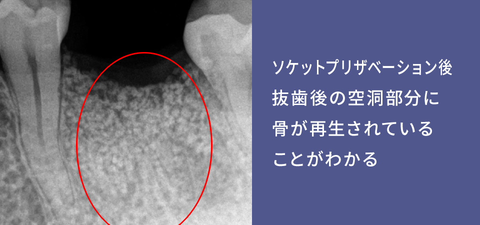 ソケットプリザベーション後 渋谷 歯医者